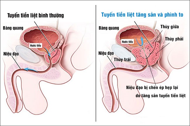 Tăng sản lành tính tiền liệt tuyến