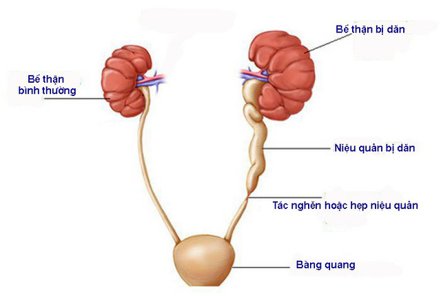 Hẹp tắc niệu quản