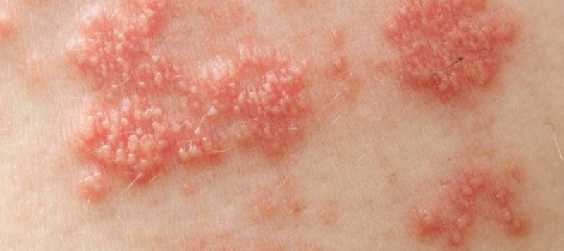 Bệnh Herpes Zoster: Triệu Chứng, Nguyên Nhân và Cách Điều Trị Hiệu Quả