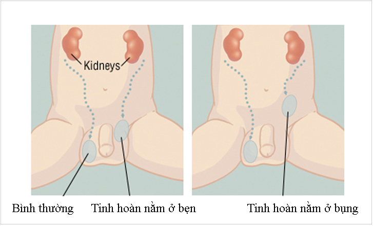 Tinh hoàn ẩn là một bệnh lý bẩm sinh thường hay gặp ở trẻ nam