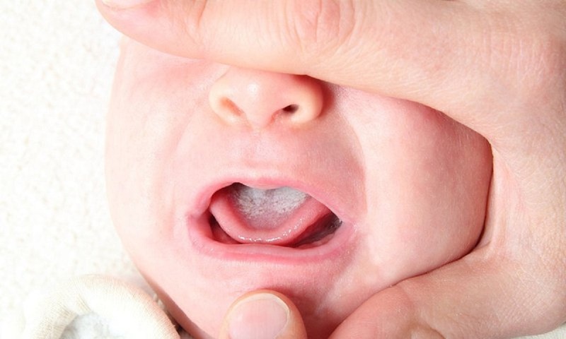 Trẻ bị nấm lưỡi, miệng là vấn đề sức khỏe rất thường gặp