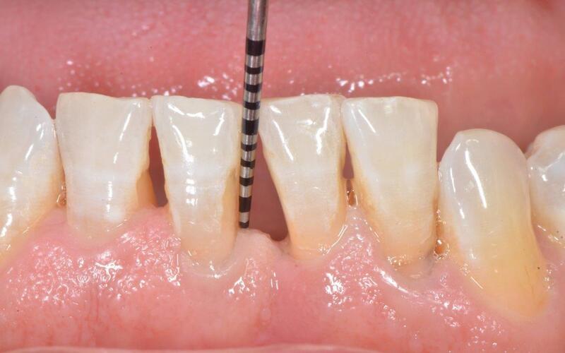 Cách điều trị tụt nướu hiệu quả và cách chăm sóc răng miệng