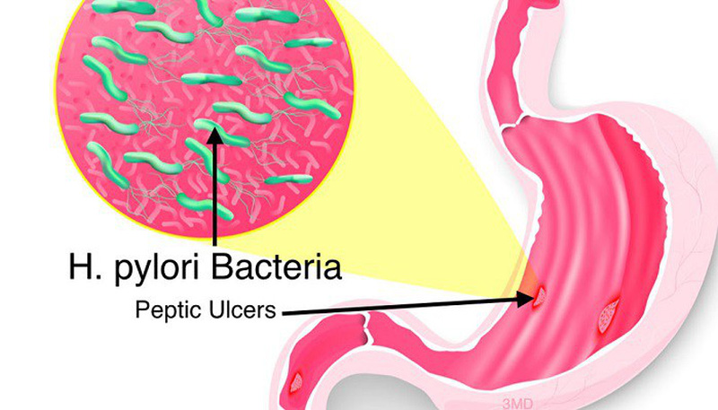 Vi khuẩn HP gây viêm loét dạ dày có thể là một trong những nguyên nhân gây ung thư dạ dày