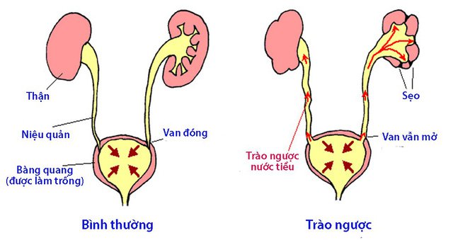 ‎Trào ngược bàng quang niệu quản (VUR) và nhiễm trùng đường tiết niệu (UTI) thường liên quan mật thiết với nhau.