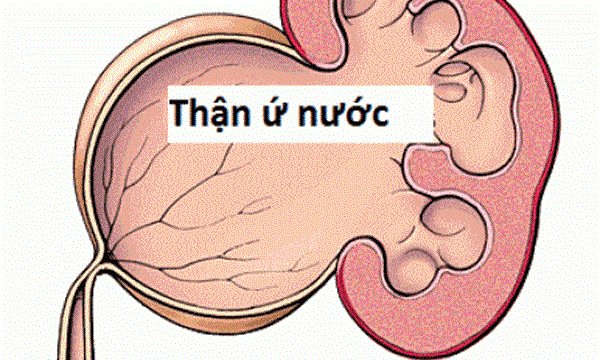 Ứ nước bể thận là một tình trạng thường xảy ra khi ‎‎thận - bể thận‎‎ bị giãn to ra do ứ đọng nước tiểu không lưu thông đúng cách từ thận đến bàng quang