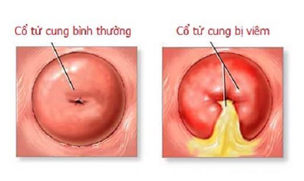 Viêm cổ tử cung là tình trạng viêm nhiễm ở cổ tử cung