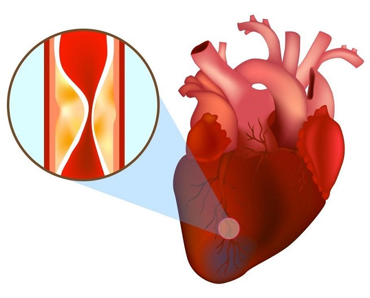 Nhồi máu cơ tim cấp