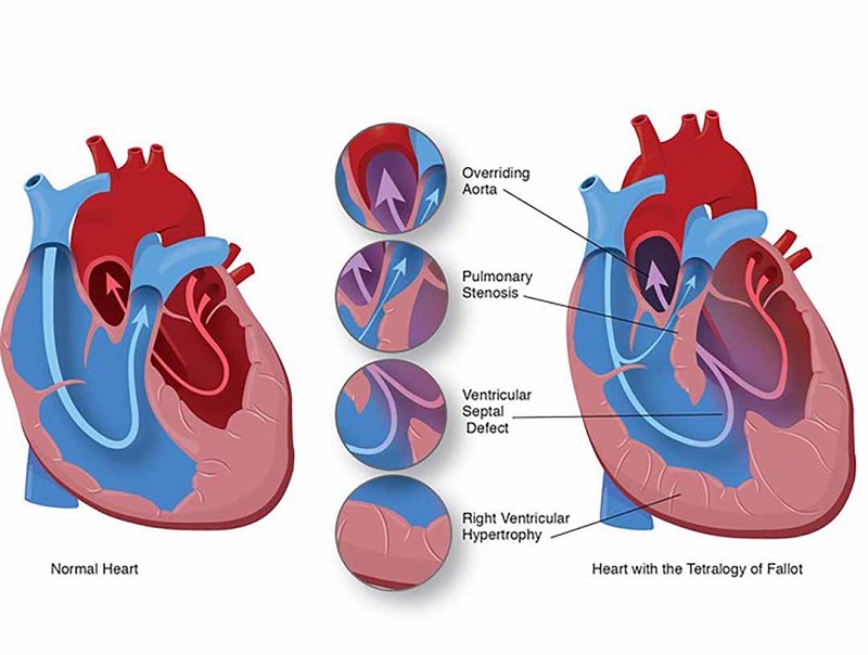 Hẹp van động mạch phổi: Chiếm khoảng 2/3 các ca tứ chứng Fallot.