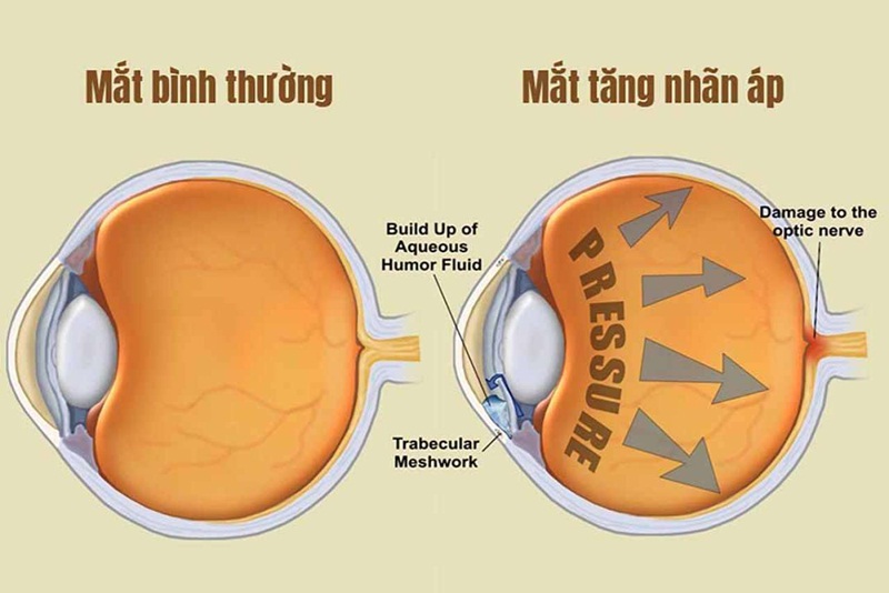 Bệnh tăng nhãn áp có thể gây ra những hậu quả nghiêm trọng