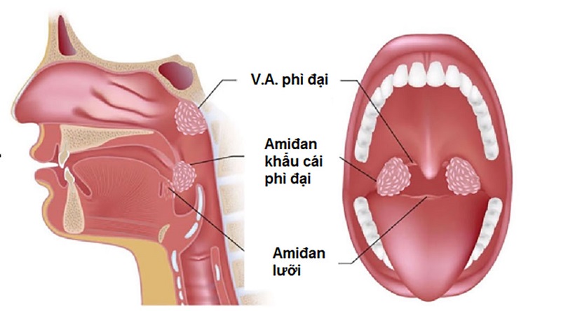 Viêm VA Mãn Tính: Triệu Chứng, Nguyên Nhân và Phương Pháp Điều Trị Hiệu Quả