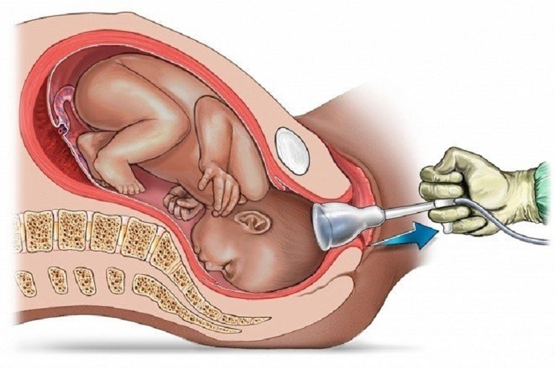 Hình ảnh mô tả hỗ trợ sinh bằng giác hút