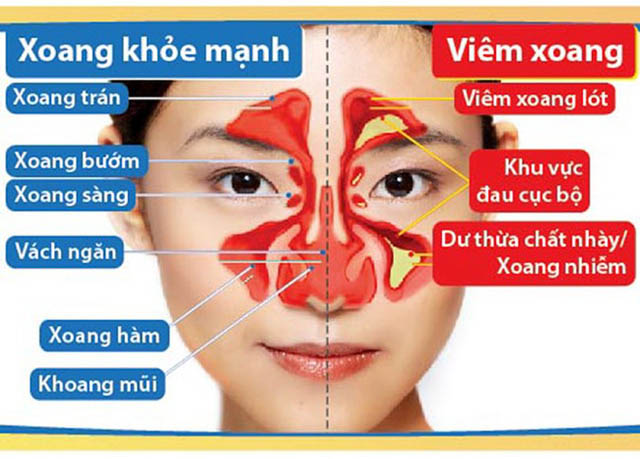 Viêm xoang là tình trạng viêm các xoang