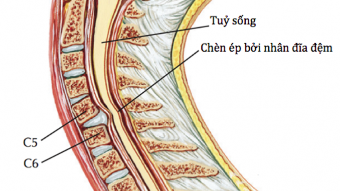 Thường gặp là thoát vị đĩa đệm cột sống cổ và đĩa đệm cột sống thắt lưng