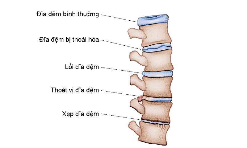 Hình ảnh mô tả đĩa đệm bình thường và đĩa đệm có bệnh lý