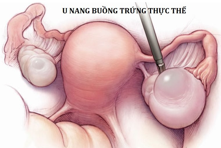 U nang thực thể