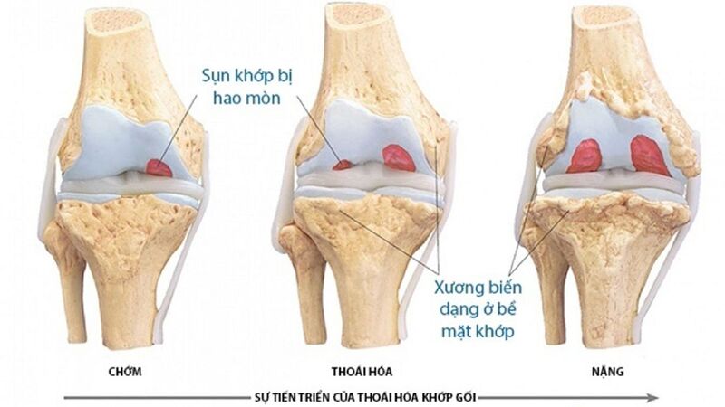 Dùng gậy đúng cách giúp người thoái hóa khớp gối giảm đáng kể sự phát triển bệnh