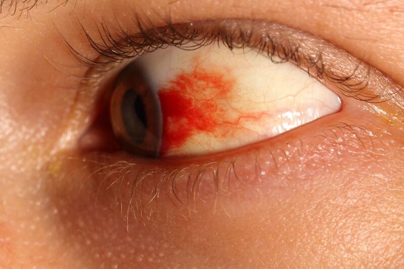  Xuất huyết dưới mắt xảy ra do vỡ mạch máu nhỏ dưới mắt