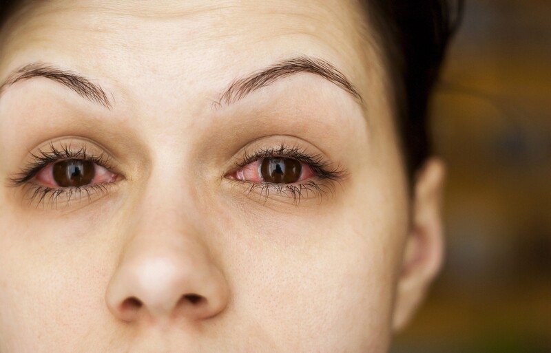  Tình trạng xuất huyết dưới mắt sẽ dần cải thiện sau vài ngày