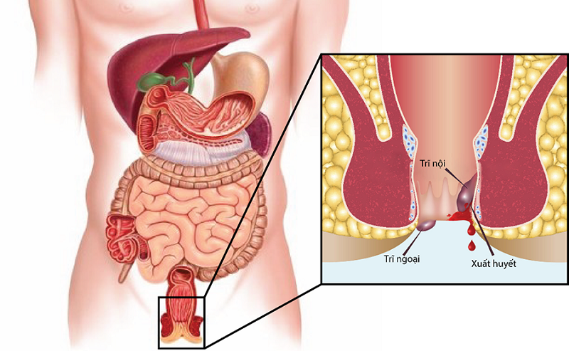 Người bị bệnh trĩ không nên vì biết ớt nhiều vitamin gì tốt cho sức khỏe mà ăn nhiều loại gia vị này vì nó dễ làm xuất huyết búi trĩ