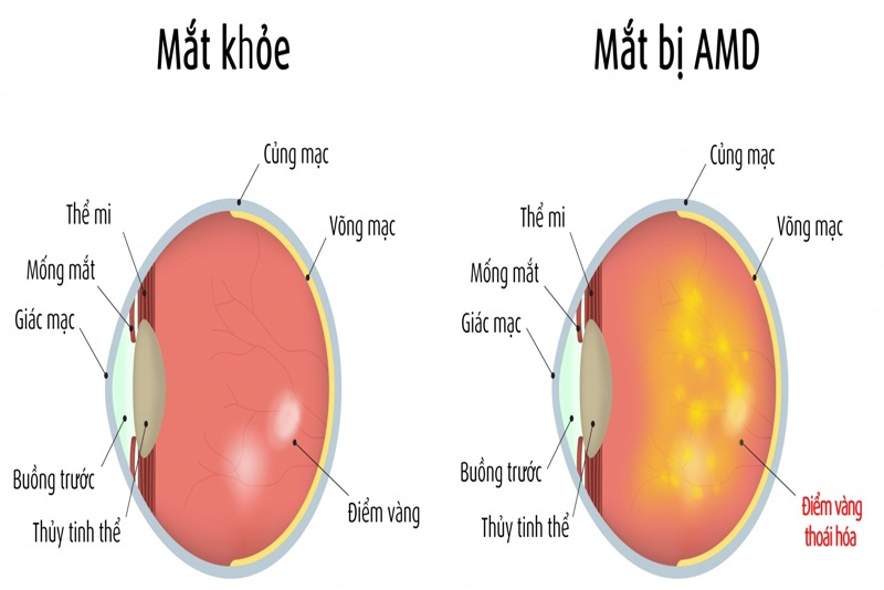 Bệnh thoái hóa điểm vàng AMD còn được gọi là thoái hóa hoàng điểm