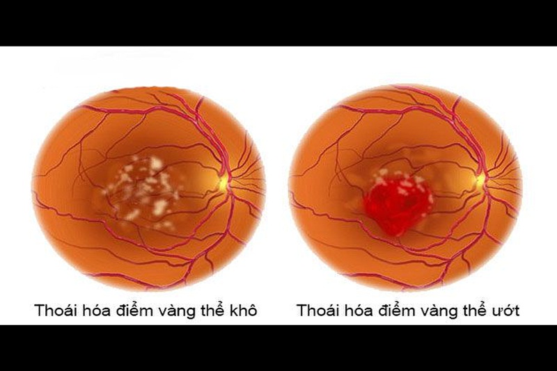 Bệnh thoái hóa điểm vàng được chia làm 2 loại đó là thoái hóa điểm vàng thể khô và thể ướt