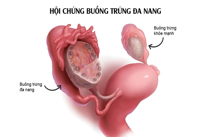 Phụ nữ bị bệnh buồng trứng đa nang thường có thể tích trứng to hơn bình thường, số lượng trứng cũng nhiều hơn bình thường