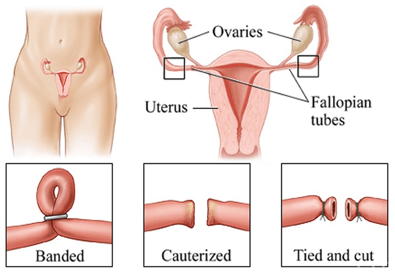 Sinh thường bao lâu có thể thắt ống dẫn trứng