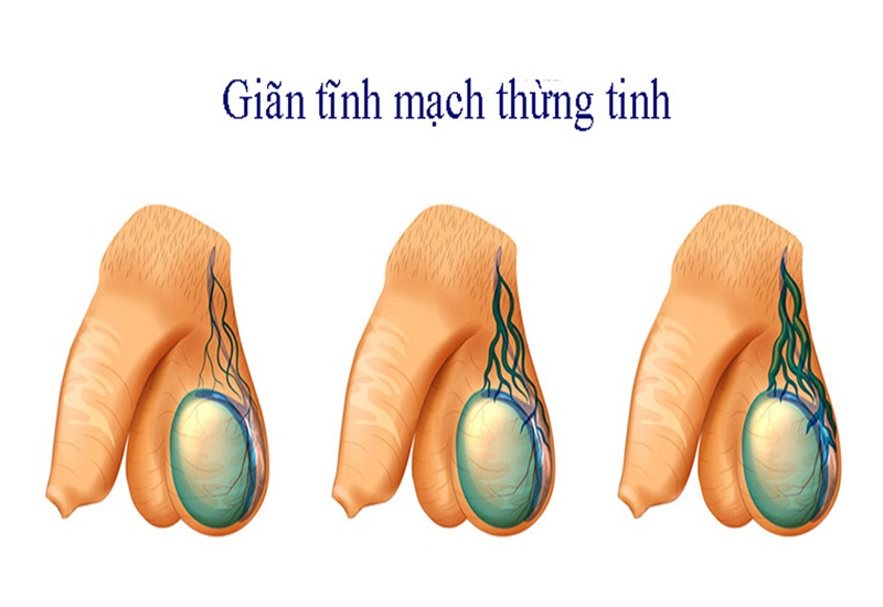 Mạch máu nổi ở tinh hoàn