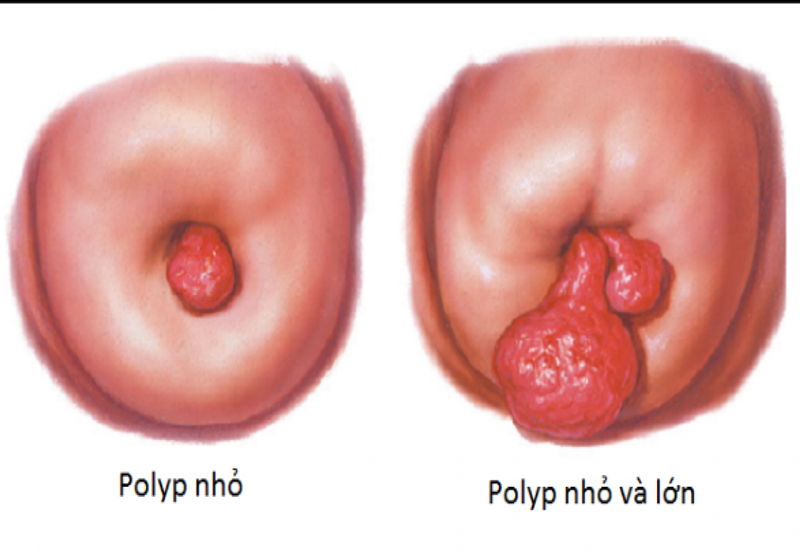 Polyp tử cung tái phát nhiều lần