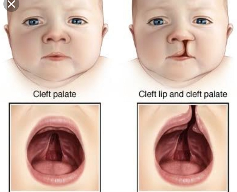 Những dị dạng thường gặp ở trẻ bị hội chứng DiGeorge 