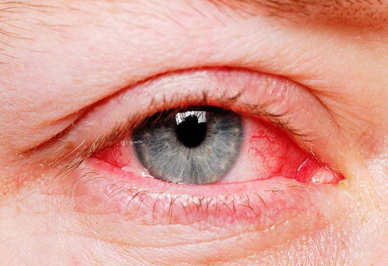 Viêm kết mạc gây ra tình trạng mắt có nhiều tia máu đỏ