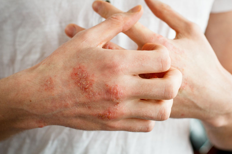 Bệnh viêm da dị ứng ở tay chân gây mất thẩm mỹ cho làn da