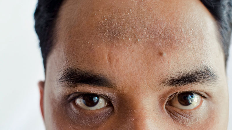 Khi bị viêm da hoặc dị ứng, làn da của bạn trở nên khô ráp và bong tróc