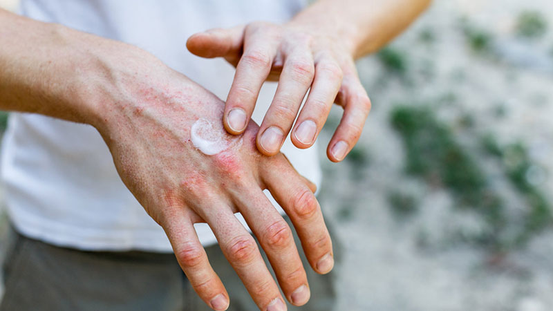 Trong quá trình điều trị, bạn nên dùng kem dưỡng để cung cấp đủ ẩm cho làn da