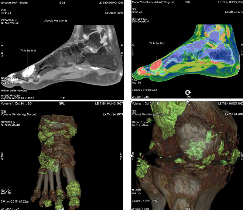 Vai trò của chụp cắt lớp vi tính hai mức năng lượng trong đánh giá bệnh gút