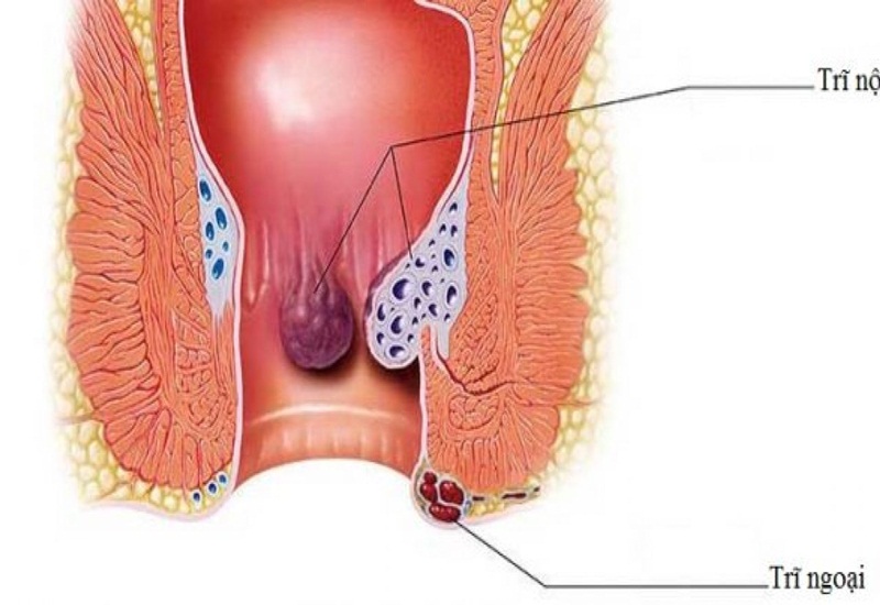 Táo bón lâu ngày gây bệnh trĩ