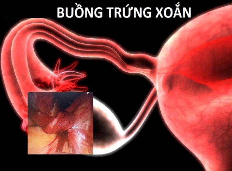 Buồng trứng bị xoắn