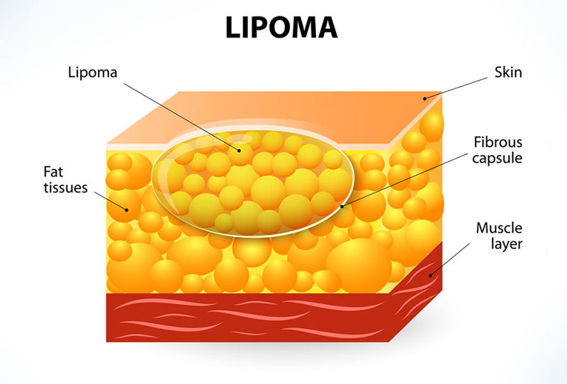 Tổng quan về bệnh u mỡ