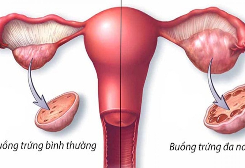 cách điều trị vô sinh thứ phát