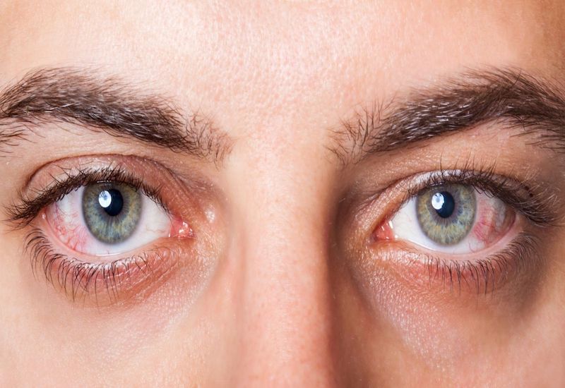 Viêm kết mạc cũng là một trong các nguyên nhân khiến mắt đổ nhiều ghèn