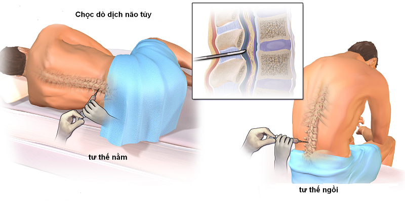 Tư thế sinh thiết tủy xương cho người bệnh