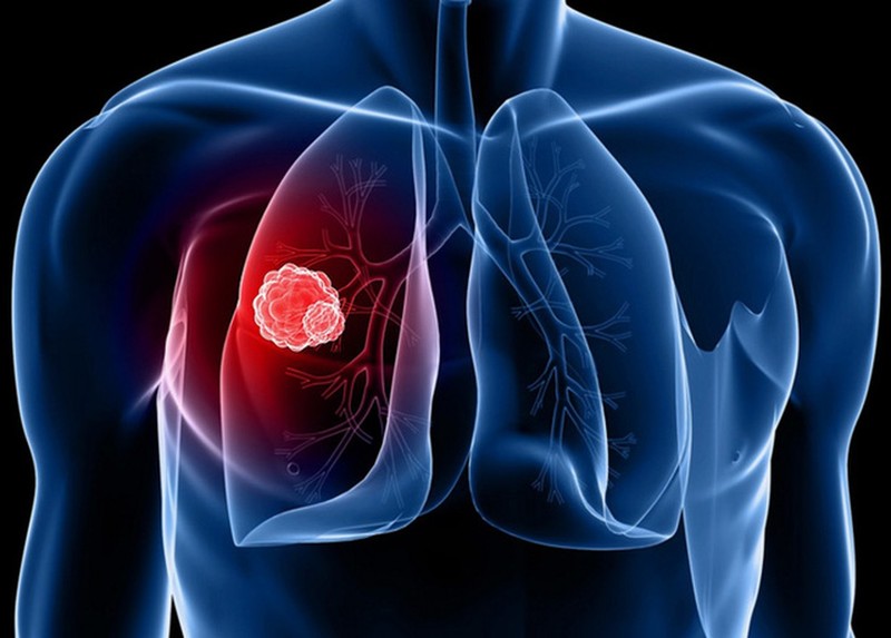 Nồng độ CYFRA 21-1 cao nhất là trong ung thư phổi
