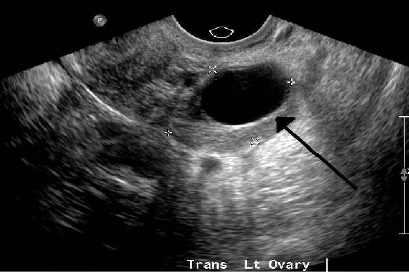 Nang trống âm buồng trứng được xem là dấu hiệu ban đầu của u nang buồng trứng