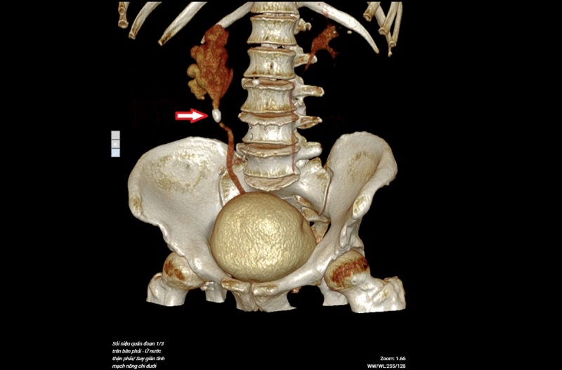 Hình ảnh chụp cắt lớp vi tính phát hiện sỏi niệu quản