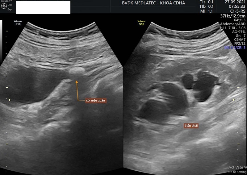 Hình ảnh siêu âm phát hiện sỏi niệu quản 