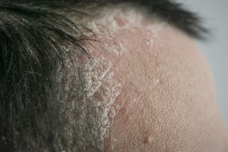 Bệnh nấm da đầu do hai loại nấm sợi là Microsporum và Trichophyton gây ra.