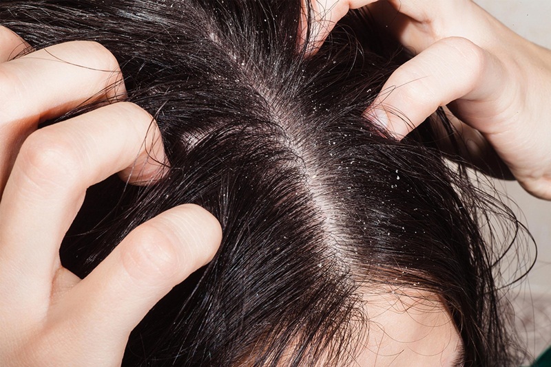 Nấm da đầu gây ra nhiều triệu chứng khó chịu cho người bệnh