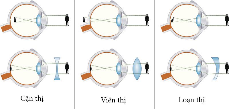 phân biệt loạn thị với cận thị