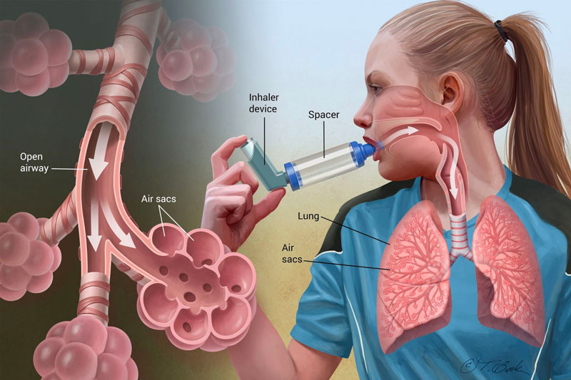 Điều trị hen phế quản đúng cách