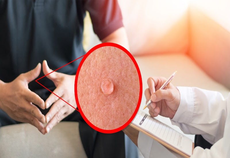 Bệnh sùi mào gà ở nam là bệnh khá phổ biến, do virus HPV gây ra